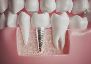 Achieve a Radiant Smile with The Dental Implant Place in Fort Worth